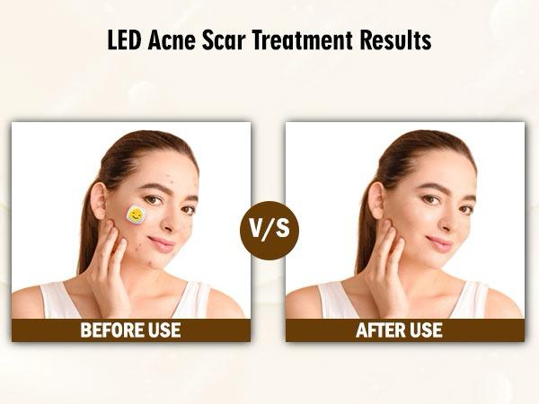 ENLIWISH Electronic Acne Patches Light Therapy Pimple Patch Red Light Zit Patches 6-Packs, Use 6-8 hours💫💥