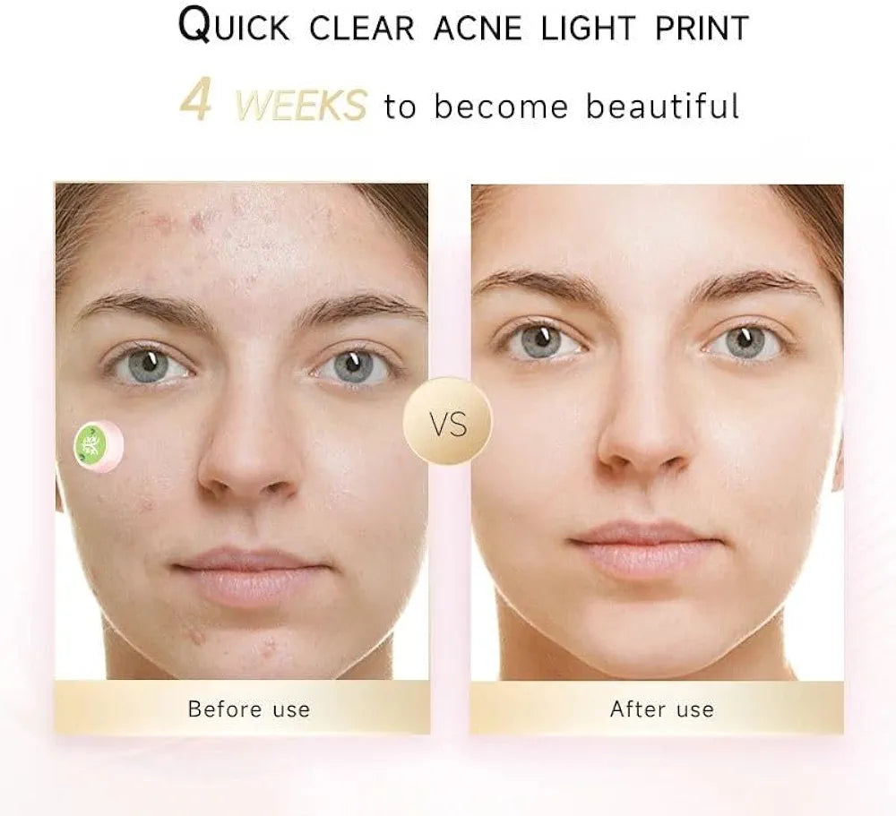 ENLIWISH Electronic Acne Patches Light Therapy Pimple Patch Red Light Zit Patches 6-Packs, Use 6-8 hours💫💥